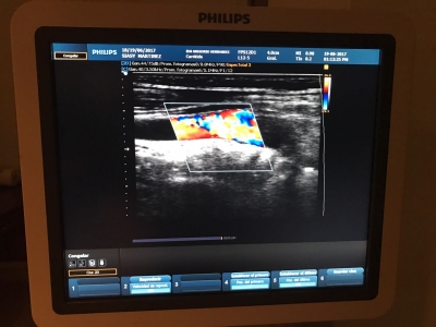 Ecodoppler de las Arterias